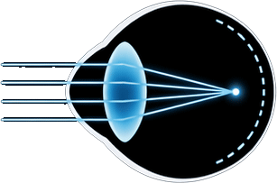 Myopia